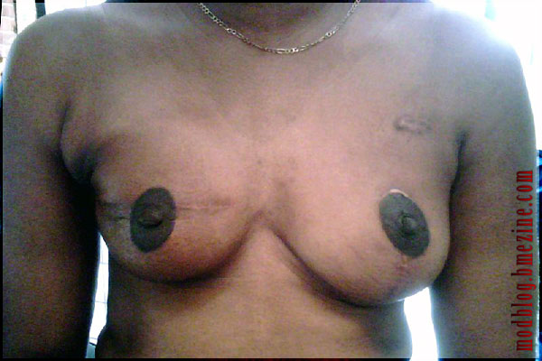 After - Tattooed Nipple Reconstruction