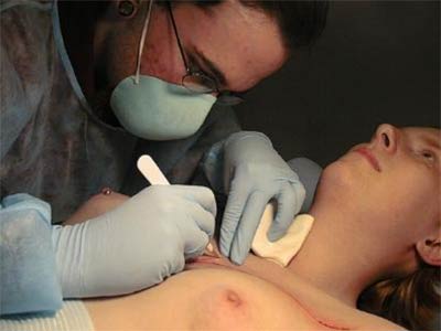 Skin removal scarification by iam:The Fog