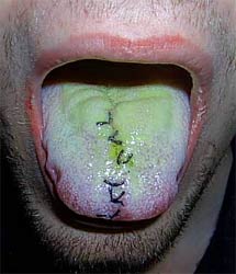 Tongue healing split Does your
