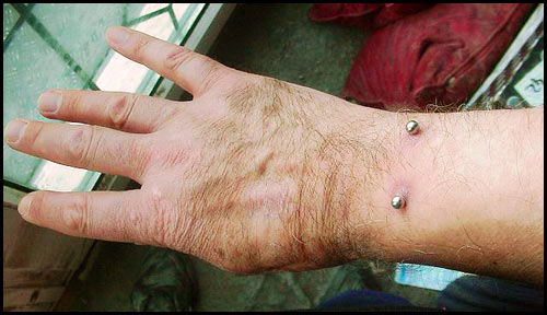 Don's four year old wrist piercing