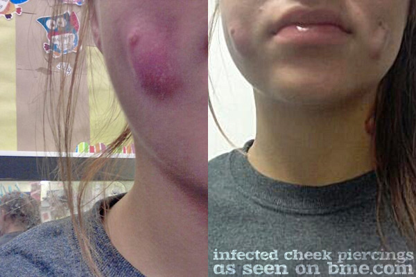 cheek infection