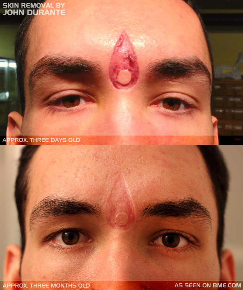 scarification healed face